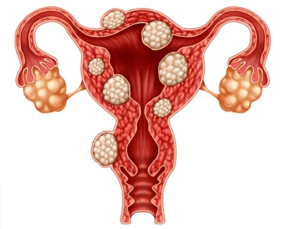 Fibromul uterin