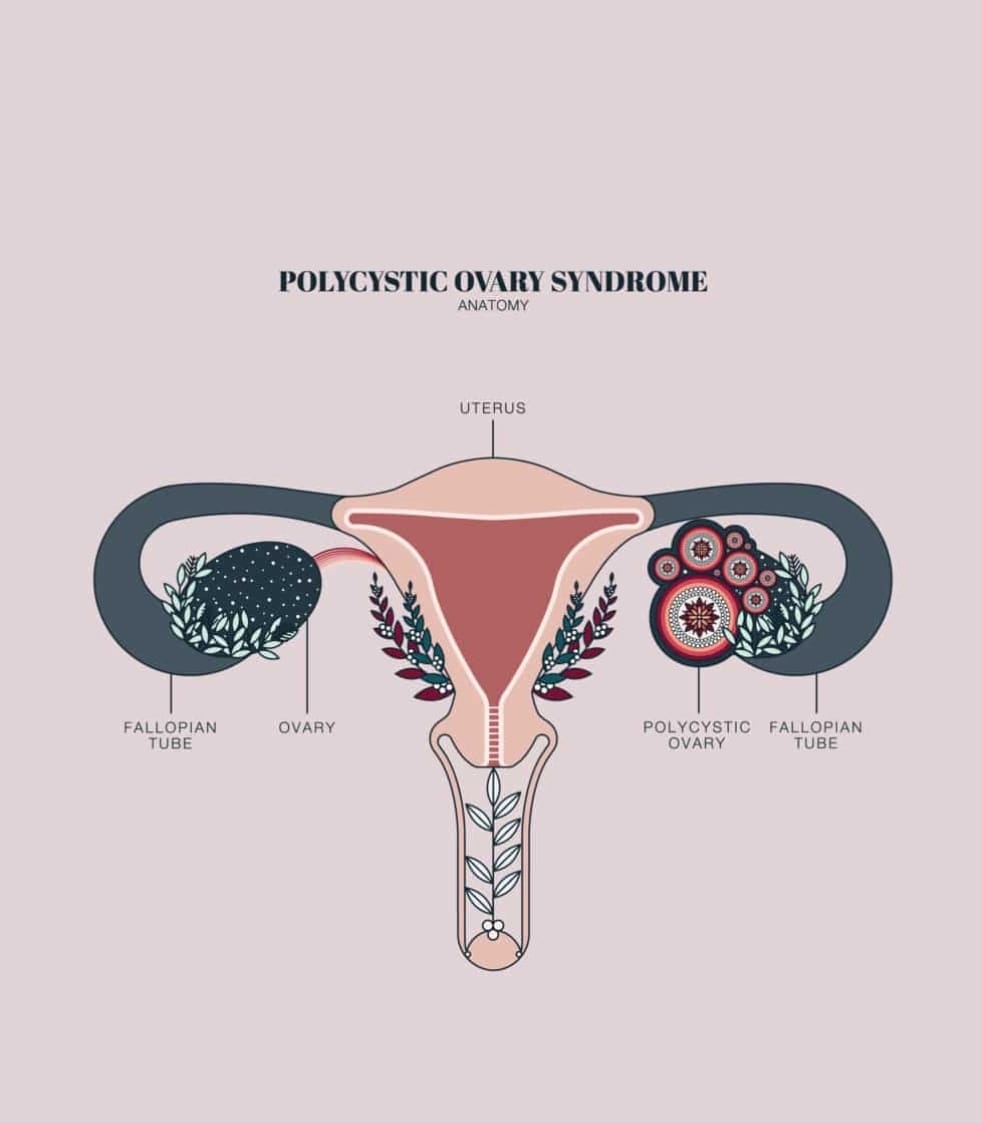 Boala Ovarului polichistic (micropolichistic)