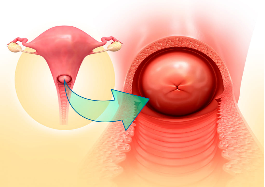 Polipul endometrial si polipul endocervical