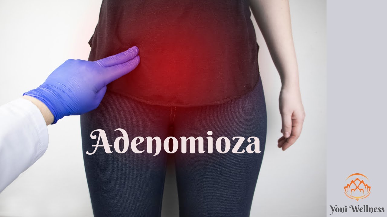S2. Ep 50 - Adenomioza | Ce are în comun cu endometrioza | Simptome | Cum se tratează?