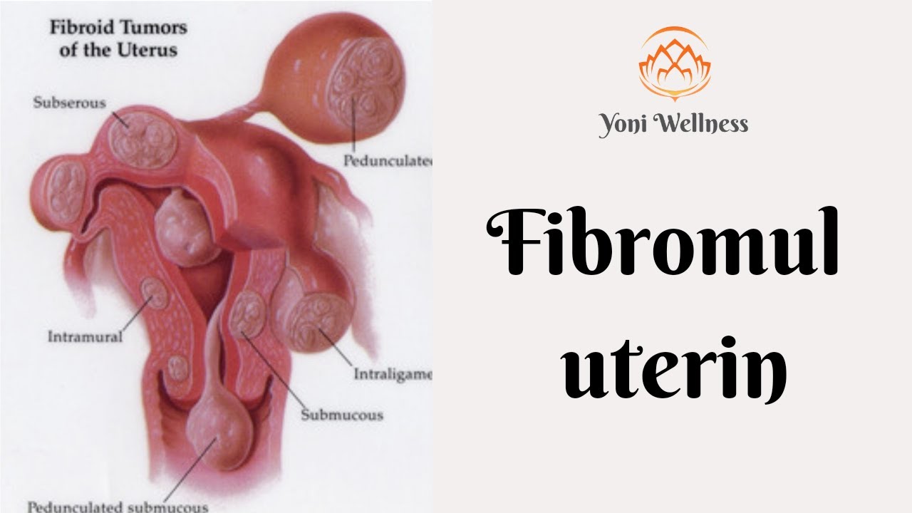 S2. Ep 24 - Fibromul uterin | De la ce apare ? | Simptome | Cum se tratează ? | Cum il prevenim ?