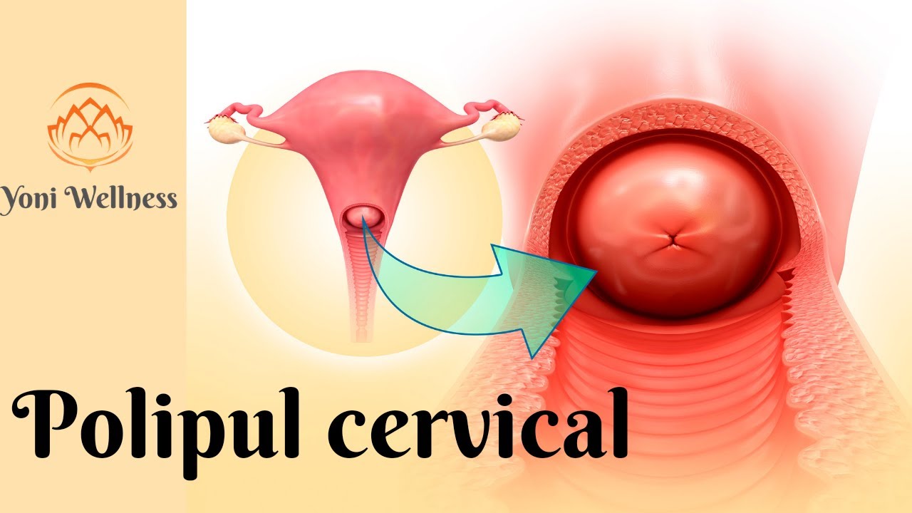S2. Ep21 - Polipul cervical | Polipul colului uterin | Cauze, simptome, tratament, complicații