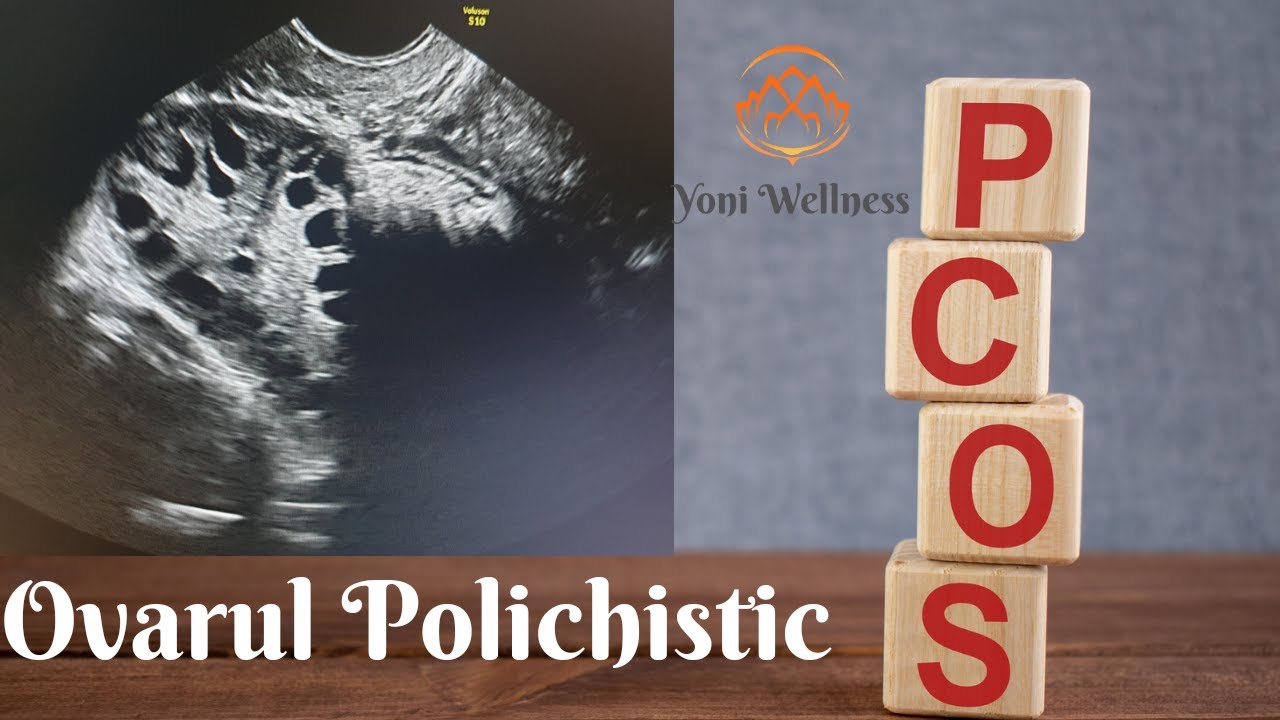 S2. Ep 19 - Boala Ovarului Polichistic | PCOS | Simptome | Diagnosic | Tratament | Sarcina