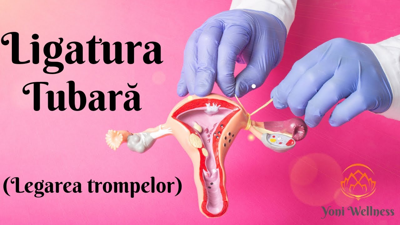 S2. Ep 11 - Ligatura tubară | Legarea trompelor uterine | Sterilizarea chirurgicală feminină