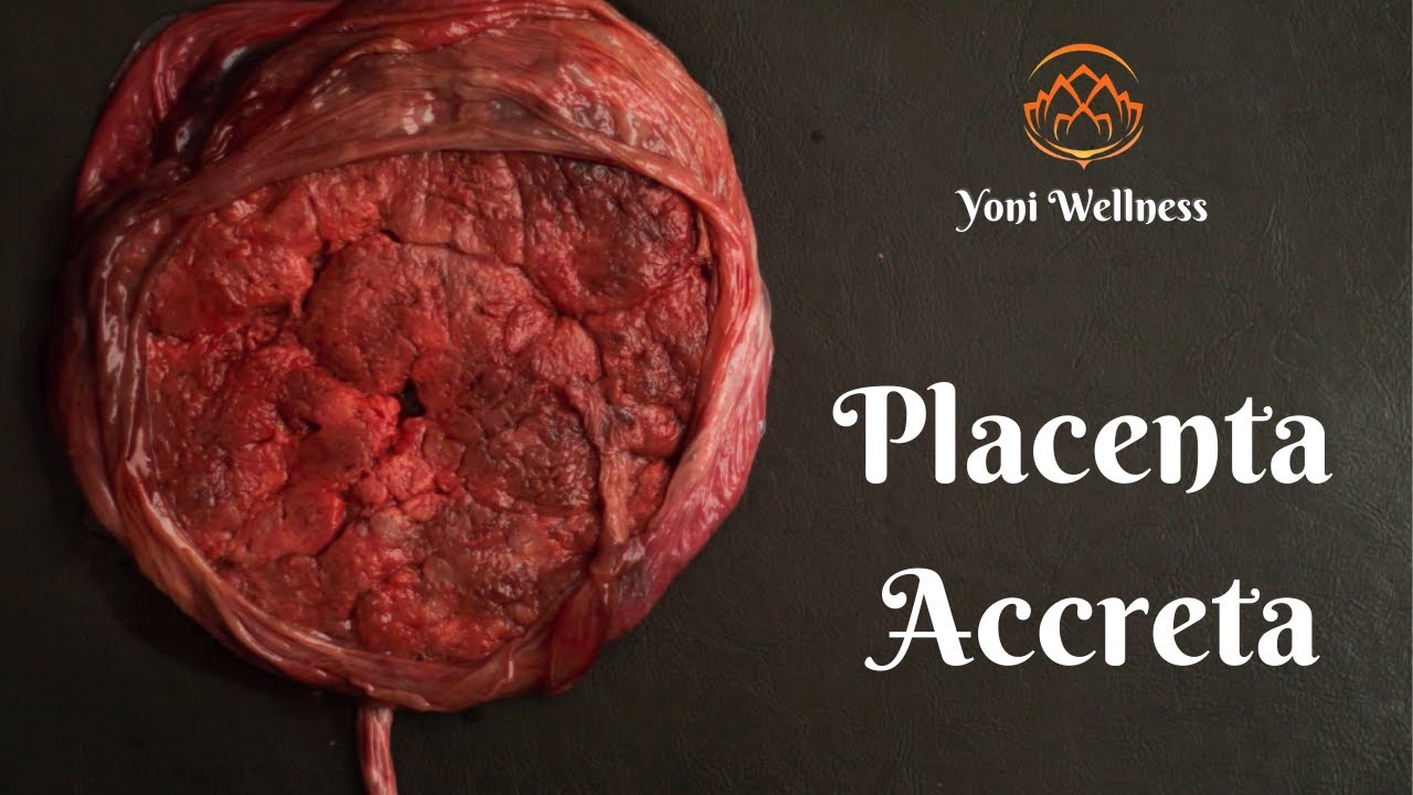 S1.Ep41: Placenta Accreta | Placenta Increta | Placenta Percreta | Simptome şi posibile complicații